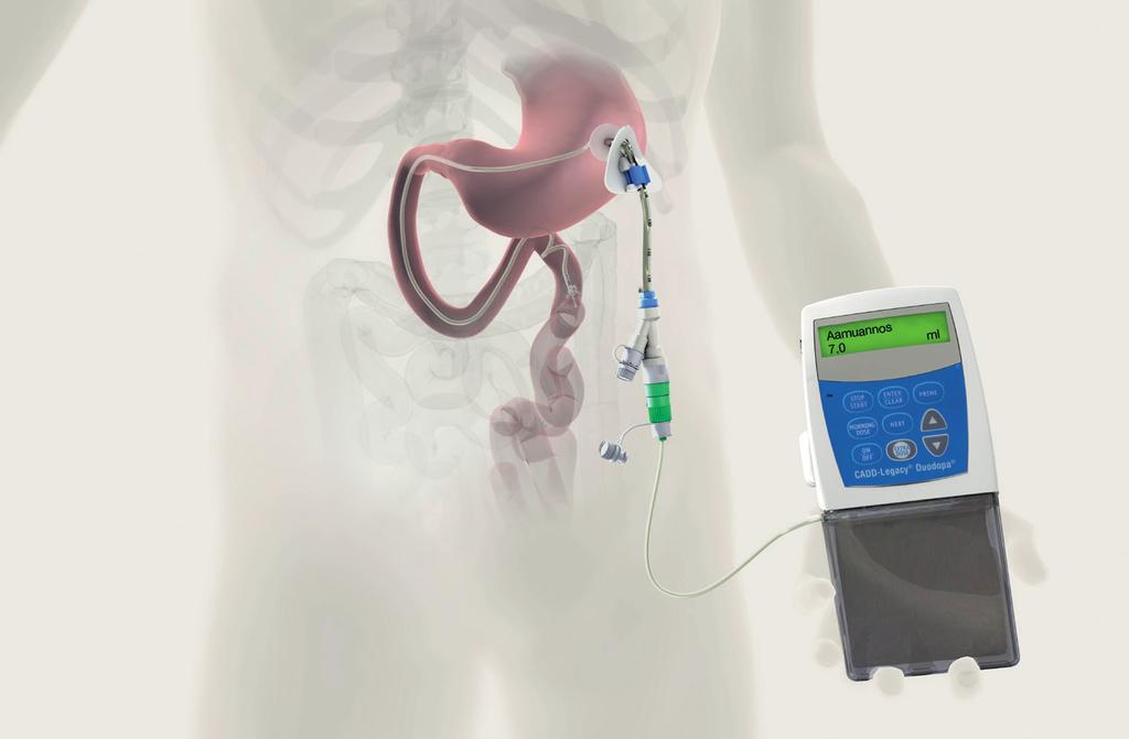 DUODOPA-INFUSIONSSYSTEM DAGLIGA BEHANDLINGSRELATERADE SYSSLOR 1. PEG-slang 2. Innerslang 3.