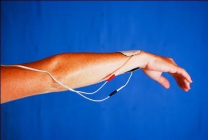 Illamående: Svart elektrod placeras tre fingerbredder proximalt från handleden på insidan av underarmen,
