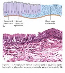 Obesitas Metaplasi Vanligen en kombination av hyperplasi och hypertrofi av adipocyter Hypertrofisk fetma är associerad med en mild (subakut) inflammation och insulin- resistens (metabola syndromet)