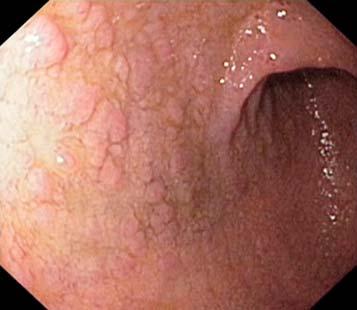 Ventrikel metaplasi i duodenum Dysplasi Rubbad proliferation och utmognad av celler i epitelial vävnad Variation i cellers storlek och form