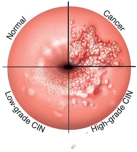 Dysplasi cancer in situ