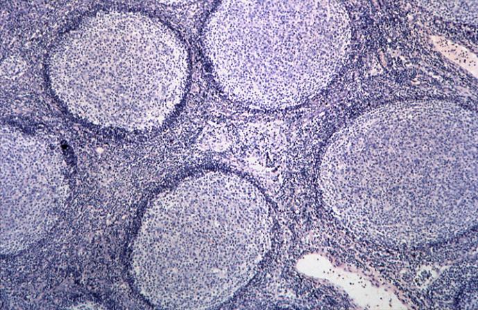 Mikroskopbild FL follicular B-och