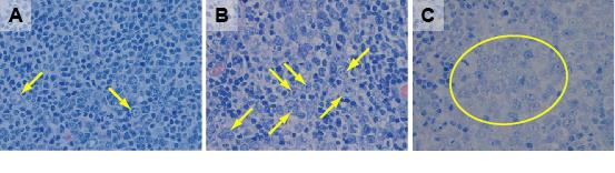 Diagnosis Follikulärt lymfom WHO Grad 1-2 - 3a / 3b Grad 1 Grad 2 Grad 3 Grad 3 >15 centroblaster per high-power field 10