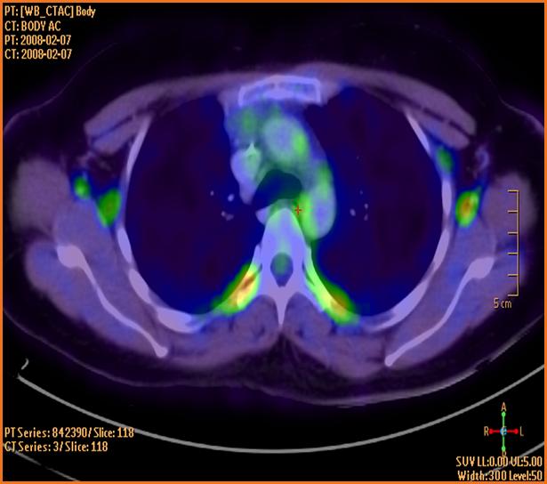 emmissions tomografi