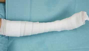 X -LITE CLASSIC Cirkulärt underbensgips med valfri dorsal förstärkningsskena.
