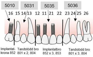 100 Sammanbundna konstruktioner kan vara Tandstödda broar Implantatstödda broar Kombinationsbroar mellan tänder och implantat Sammanlödda tandstödda kronor Sammanlödda implantatstödda kronor I det