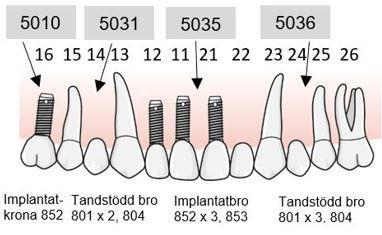 Exempel, sammanbunden konstruktion eller enskilda konstruktioner, båda alternativen ersätts inom tandvårdsstödet Bilderna visar protetisk behandling av - friändstandlöshet bakom 15, tillstånd 5010, -