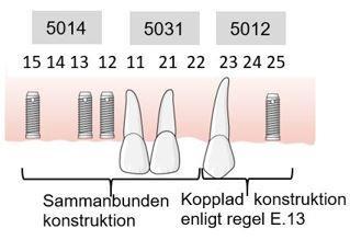 101 Exempel, sammanbunden konstruktion där regel E.13 kan tillämpas för del av konstruktionen En patient har tänderna 11, 21 och 23 kvar i överkäken.