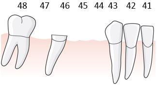 111 I regel E.3 anges vidare att vid tandlöshet som involverar tandposition 5 och stödtand finns i position 6, men saknas i position 7, kan en tandstödd bro utsträckas till tandposition 8.