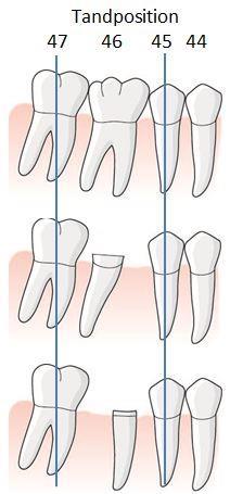 112 Exempel, En tand byter inte position för att den separeras Den separerade molaren är fortfarande en