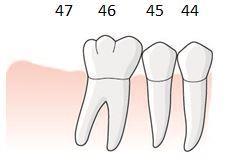 113 Exempel, entandslucka uppkommer efter separation av mesiala roten av tand i position 6 i överkäken, tillstånd 5031 En patient har tänderna 16 11 i höger överkäke.