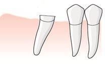 Tanden 16 står något mesiobuckalroterad vilket medför att efter operationen har en tandlucka uppkommit mellan 15 och den kvarvarande delen av 16.