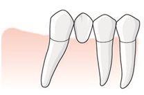 Det framgår av de allmänna råden för tillstånd 5031 och 5036 att dessa tillstånd även kan avse en tandlucka som uppkommer efter separation av en molar i position 6.
