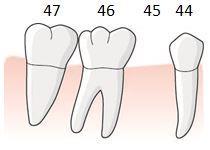 114 Exempel, tand i position 5 saknas, mesiala roten av tand i position 6 avlägsnas, entandslucka position 5 med bräckligt ändstöd, tillstånd 5036 En patient har en entandslucka 45.