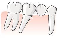 115 När bron framställs bedömer tandläkaren att det är tillräckligt med ett (1) hängande led som ersätter både den saknade 45 och mesiala delen av 46