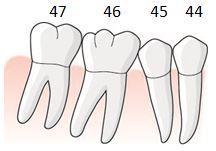 Exempel, mesiala roten av tand i position 6 avlägsnas, bro utan hängande led utförs, tillstånd 5031 En patient får tid hos sin tandläkare för att avlägsna