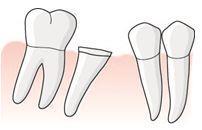 För ingreppet rapporteras åtgärd 407, Övrig dentoalveolär kirurgi eller plastik. Patienten önskar få luckan som uppkommit utfylld.