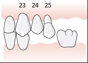 Exempel, betthöjning på grund av utrymmesbrist, tillstånd 5071 En patient har inga tänder bakom 13 på höger sida i överkäken samt en tretandslucka 24 26 på vänster sida.