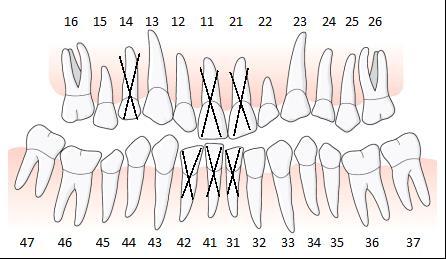 På vänster sida har tänderna 35 och 36 elongerat. Detta har medfört att ocklusionsplanet har en kraftig lutning och det kommer inte att vara möjligt att få en fungerande artikulation mot överkäken.