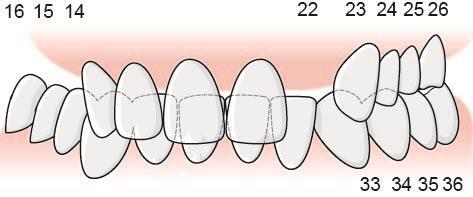 132 Exempel, tillstånd 5071 fastställs för båda tänderna i ett antagonerande tandpar En patient har i höger överkäke inga tänder kvar bakom 13 och i vänster överkäke finns en entandslucka 22.