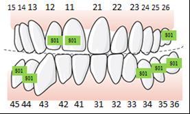 135 Exempel, otillräckligt antal ockluderande tandpar vid lateralt öppet bett, en sida, som kräver protetisk korrektion, tillstånd 5072 En patient har samtliga tänder 7 7 men saknar helt