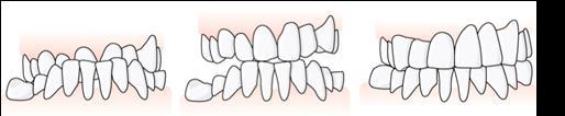 139 Exempel, otillräckligt antal ockluderande tandpar vid transversell avvikelse som kräver protetisk korrektion i båda käkar, tillstånd 5072 En patient har ett bettfel i transversalled i form av