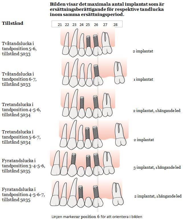147 I bilden framgår principerna för hur tandvårdsstöd lämnas för implantat vid tandluckor som involverar tandposition 6.
