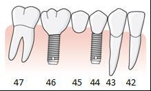 148 Exempel, implantatbehandling i en tretandslucka i position 4 6 En patient har en tretandslucka 44, 45 och 46. Tandläkaren fastställer tillstånd 5034.