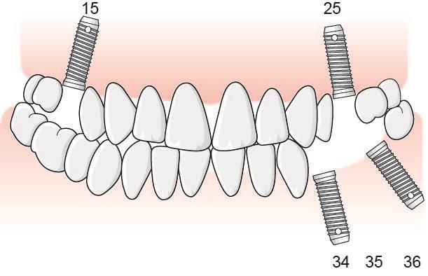 153 Exempel, samtidig operation för ersättningsberättigande implantat och implantat vid utbyte, åtgärd 423 och 925 En patient saknar tänder i position 15, 25 och 34 36, i övrigt finns samtliga tänder.