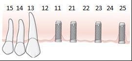 168 Åtgärd 855, Fästskruv/broskruv och cylinder vid semipermanent krona på implantat, per implantat. Referenspriset har beräknats på metallcylinder och fästskruv/broskruv i titan.
