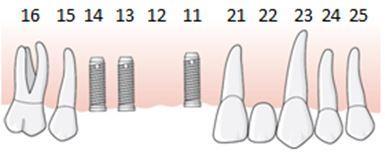 170 Exempel, långtidstemporär konstruktion på implantat behöver utföras i väntan på kompletterande operation, åtgärd 856 och 857 En patient har en fyratandslucka 14 11.