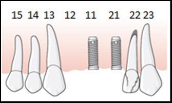 Det är karies ner i rotkanalen 23 och tanden kommer inte att kunna behållas. Vid undersökning av tanden 21 konstaterar tandläkaren att 21 har en rotspricka.