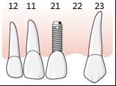 172 Tabell, tand förloras bredvid befintlig implantatkonstruktion Tand förloras bredvid befintlig implantatkonstruktion Implantat utförs bredvid befintlig implantatkonstruktion Befintlig