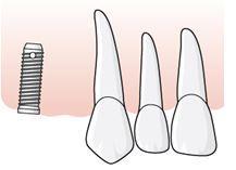 För höger överkäke fastställer tandläkaren tillstånd 5012 Enkelsidig friändstandlöshet position 4-8 saknas, och två implantat planeras i position 15 och 14.