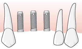 Tandläkaren fastställer tillstånd 5033, Tvåtandslucka, två implantat installeras och åtgärd 423 och 420 x 2 rapporteras. Under inläkningsperioden längsfrakturerar 12 och tanden måste extraheras.