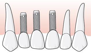 Vid implantatinstallationen rapporterar tandläkaren åtgärd 420 och 421 för tandposition 12 inom tillstånd 5034. När den protetiska behandlingen utförs har en ny ersättningsperiod påbörjats.