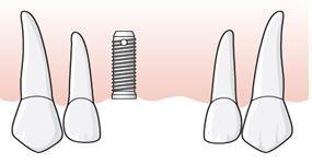 Under inläkningstiden förlorar patienten tanden 21. En tvåtandslucka, tillstånd 5033, finns eftersom regel E.