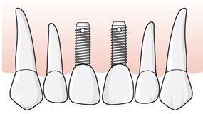 När implantatet i tandposition 21 har installerats rapporterar kirurgen åtgärd 420 och 421 inom tillstånd 5033, Tvåtandslucka.