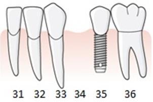 187 Exempel, tand förloras bredvid singelimplantat, det befintliga implantatet byggs ihop med en tandstödd krona till en kopplad konstruktion En patient har sedan flera år ett singelimplantat i