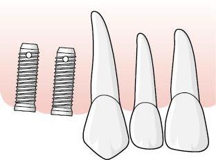188 Exempel, ersättningsperioden bryts under en implantatbehandling vid partiell tandlöshet, tillstånd 5448 En patient är tandlös bakom tandposition 13.