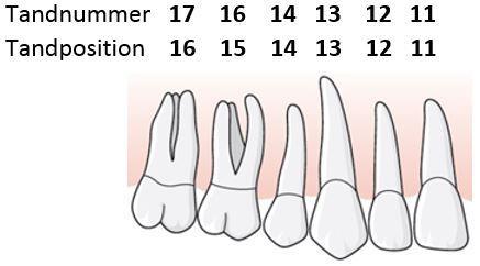 30 Exempel, tandnummer och tandposition är inte samma 1.5.2.2 Ny tandposition En patient har aplasi av sina permanenta 5:or.