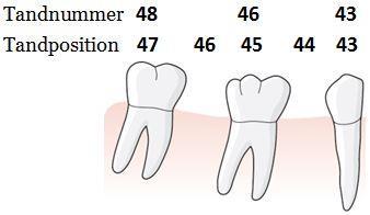 Det innebär exempelvis för den första kvadranten att tand 14 står i tandposition 14, tand 16 i tandposition 15 och tand 17 i tandposition 16.
