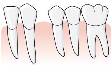 31 Exempel, tand 34 står i tandposition 35, en entandslucka har uppkommit Efter tidig extraktion av tanden 36 har en distal tandförflyttning skett av tänderna 34 och 35.