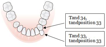 Tandluckan är bredare än halva bredden av tanden 34 och tandläkaren konstaterar därmed att tanden 33 står i tandposition 33, tanden 34 står i tandposition 35 och tanden 35 står i tandposition 36.