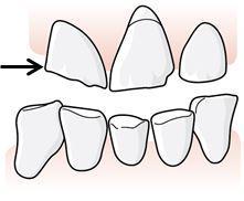 86 5.2.1.1 Olika skador på en tand kan inte adderas när en skadas omfattning ska fastställas, regel D.
