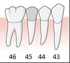 89 Exempel, krona utförts som reparativ vård, samma tand måste extraheras inom tre år, regel D.5 En patient har på grund av en omfattande fraktur fått en krona utförd på 45 inom tandvårdsstödet.
