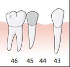 5 är inte åtgärd 804 för hängande led blockerad när en krona, åtgärd 800 eller 801, har utförts på samma tandposition. En treledsbro för entandsluckan är ersättningsberättigande inom tillstånd 5031.