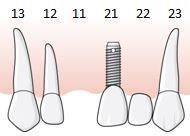 95 Exempel, befintligt implantat bredvid saknad tand ska likställas med tandlöshet, regel E.11 En patient har en implantatstödd sektionsbro i tandposition 22 25 samt egna tänder i tandposition 17 21.