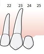 Tandläkaren fastställer tillstånd 5015, Enkelsidig friändstandlöshet där samtliga tänder i position 1 8 saknas, eftersom implantat bredvid tandlucka ska likställas med tandlöshet, se avsnitt om regel