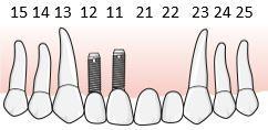 I detta fall ersätts endast den implantatstödda bron för att behandla tandluckan. Fyratandslucka 12 22, tillstånd 5035, där regel E.13 för kopplad konstruktion mellan tand och implantat kan tillämpas.